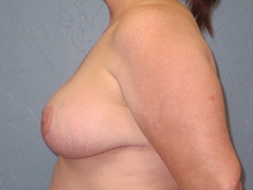 Breast Lift Before & After