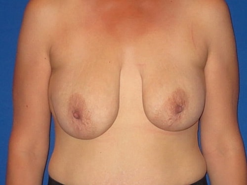 Breast Lift Before & After
