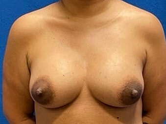 Breast Augmentation Before & After