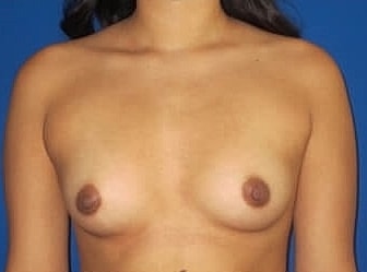 Breast Augmentation Before & After