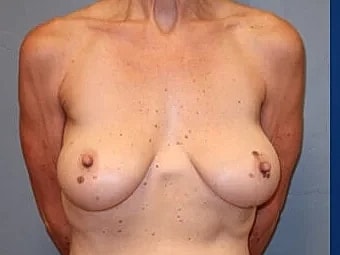 Breast Augmentation Before & After
