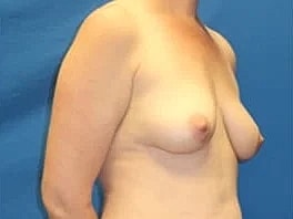 Breast Augmentation Before & After