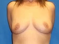Breast Augmentation Before & After