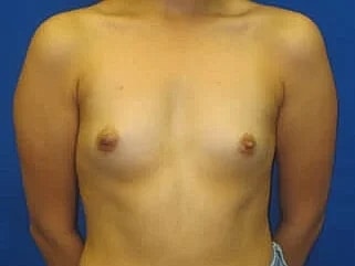 Breast Augmentation Before & After