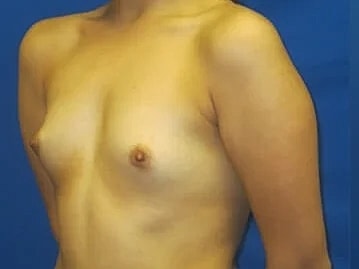 Breast Augmentation Before & After