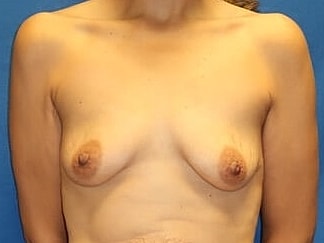Breast Augmentation Before & After