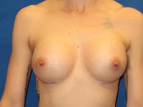 Breast Augmentation Before & After