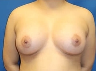 Breast Augmentation Before & After
