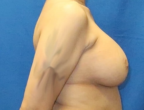 Breast Augmentation Before & After