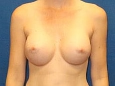 Breast Augmentation Before & After