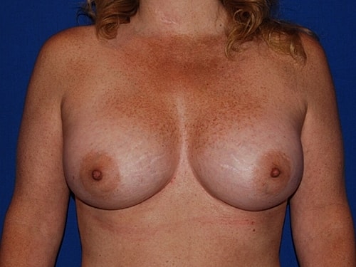 Breast Augmentation Before & After