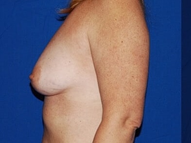 Breast Augmentation Before & After