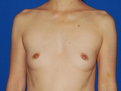 Breast Augmentation Before & After