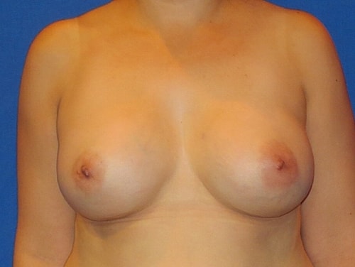 Breast Augmentation Before & After