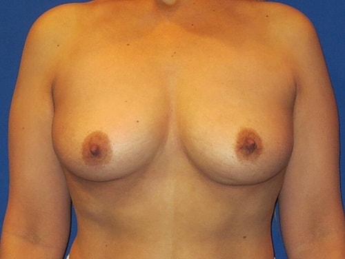 Breast Augmentation Before & After