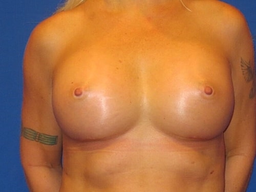 Breast Augmentation Before & After