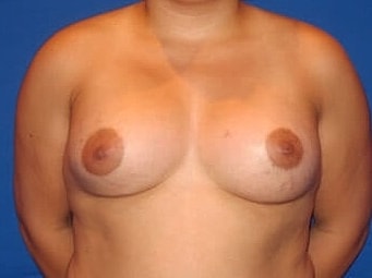 Breast Augmentation Before & After