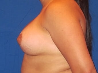 Breast Augmentation Before & After