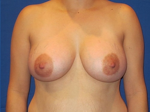 Breast Augmentation Before & After