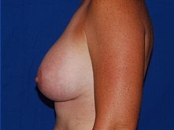 Breast Augmentation Before & After