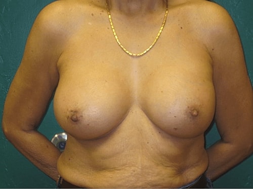 Breast Augmentation Before & After