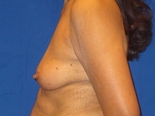 Breast Augmentation Before & After