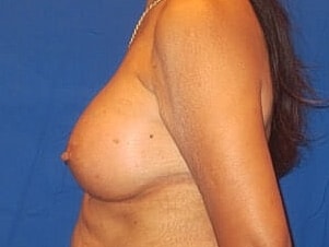 Breast Augmentation Before & After