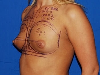 Breast Augmentation Before & After