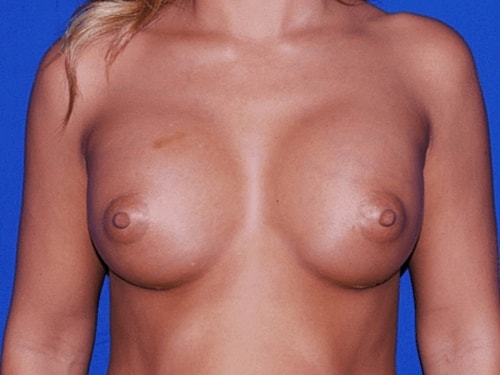 Breast Augmentation Before & After