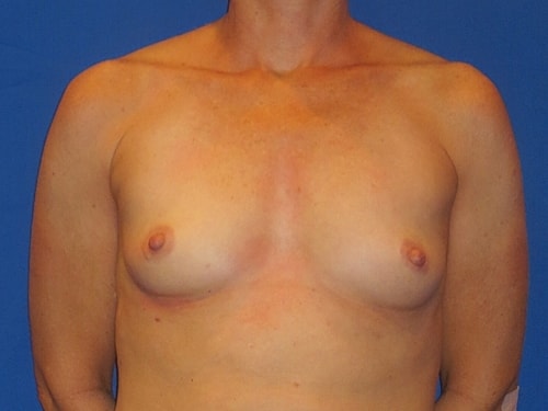 Breast Augmentation Before & After