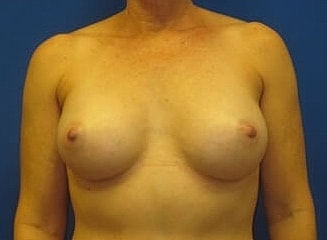 Breast Augmentation Before & After