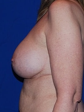 Breast Augmentation Before & After