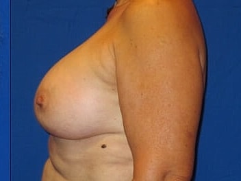 Breast Augmentation Before & After