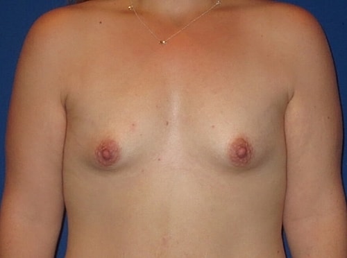Breast Augmentation Before & After