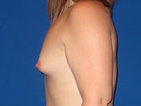 Breast Augmentation Before & After