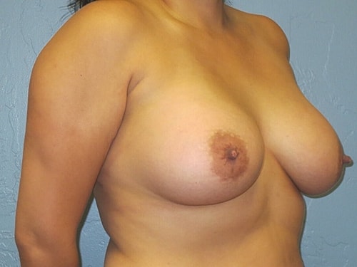 Breast Augmentation Before & After