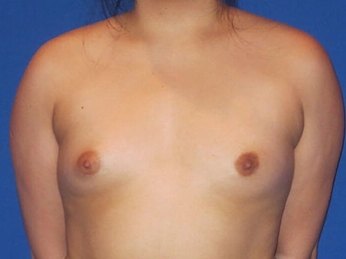 Breast Augmentation Before & After