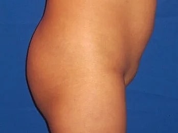 Fat Transfer Before & After