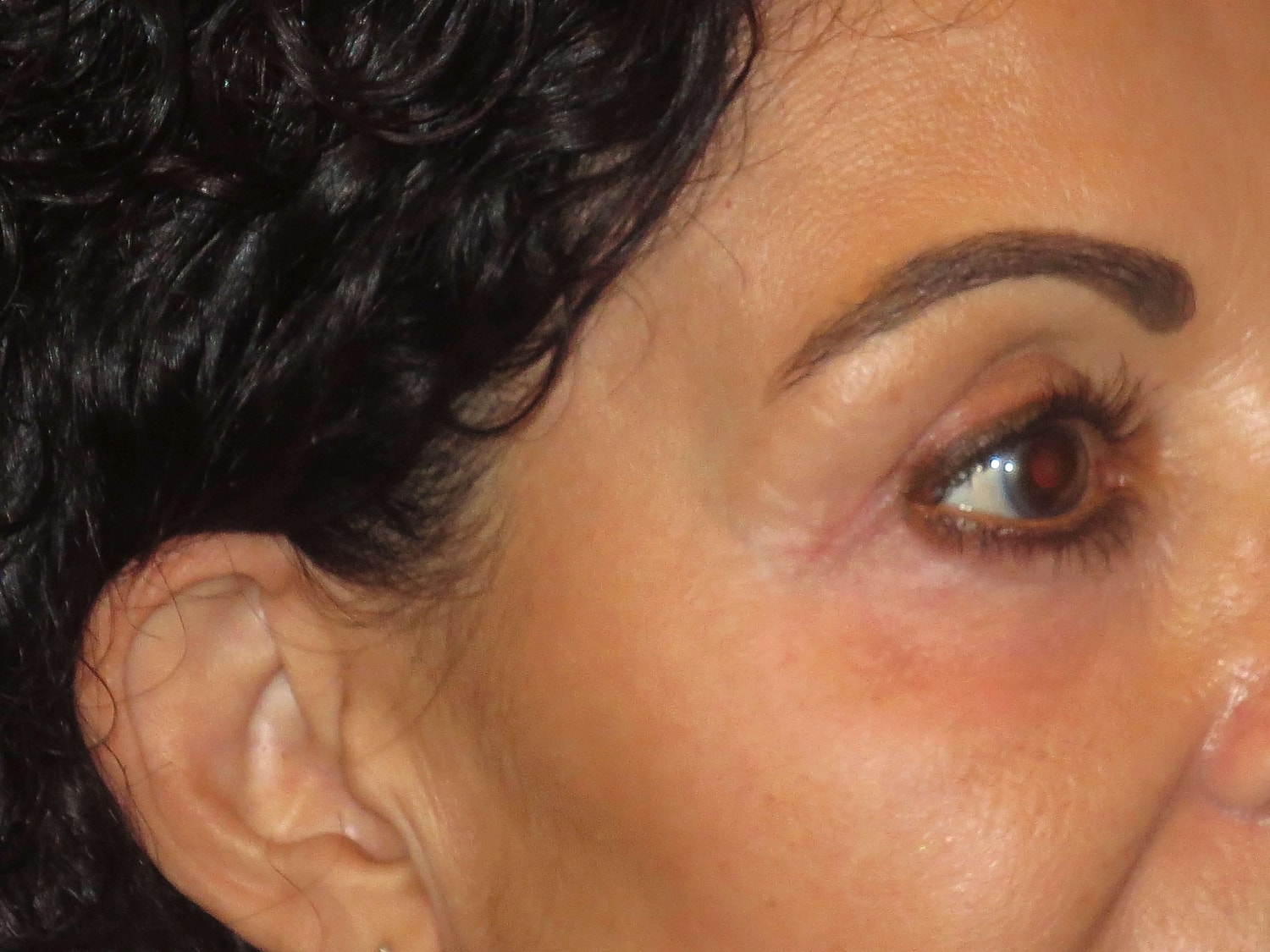 Temple Fillers Before & After