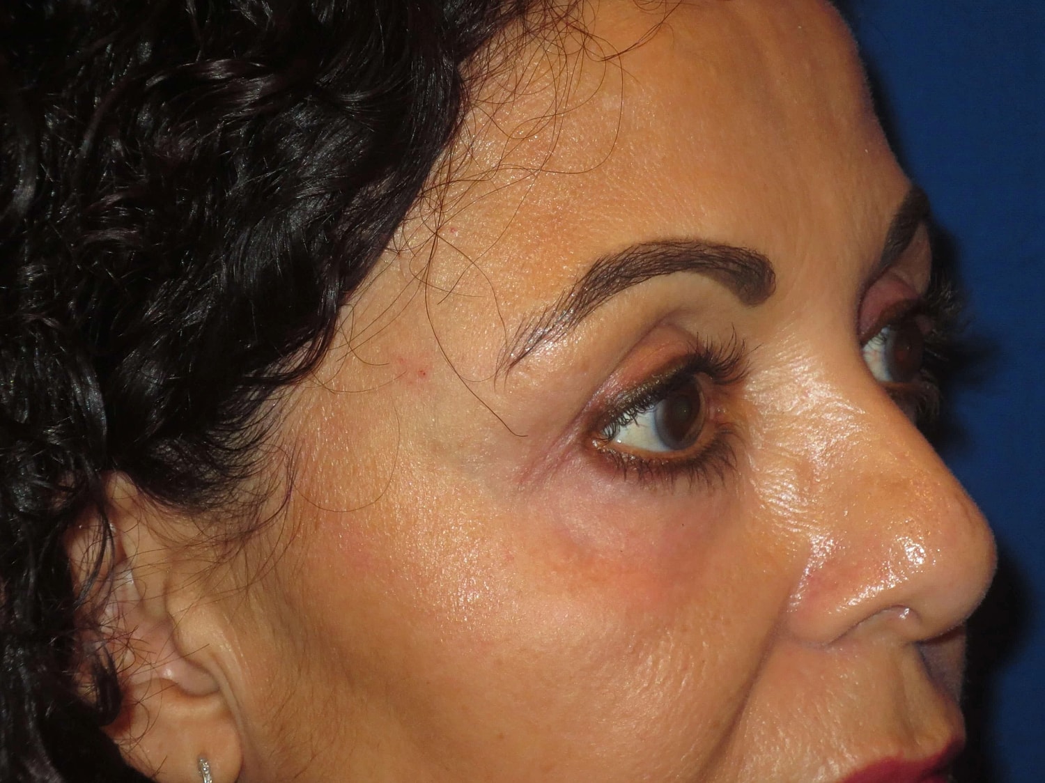 Temple Fillers Before & After