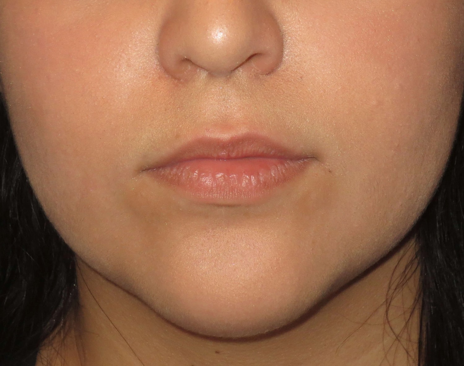Lip Filler Before & After