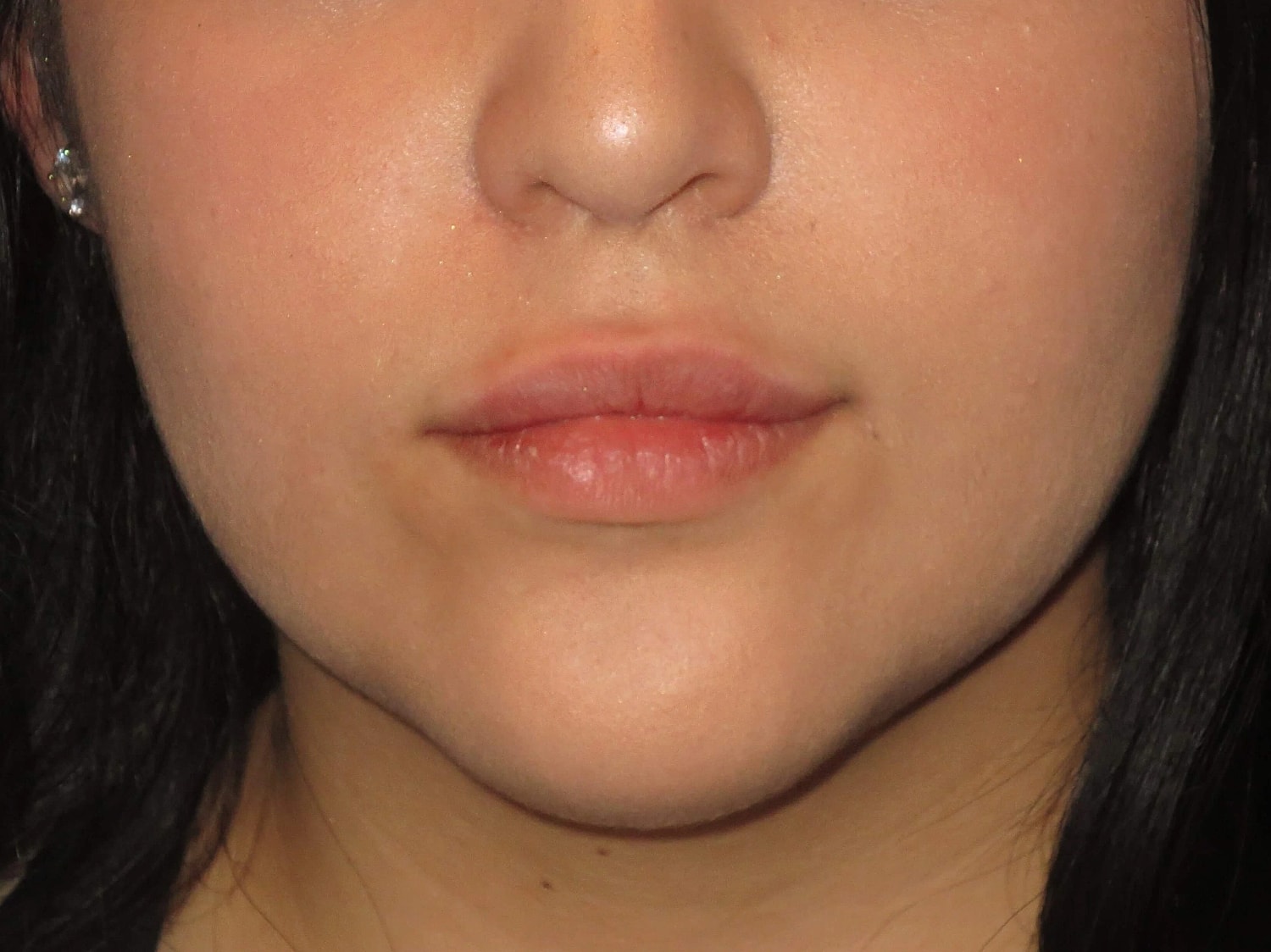 Lip Filler Before & After