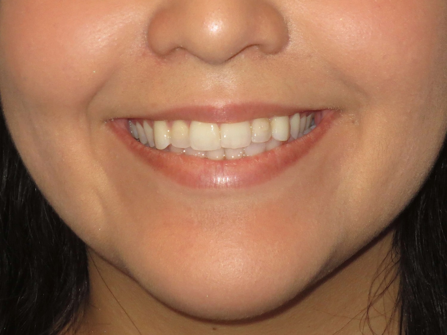 Lip Filler Before & After