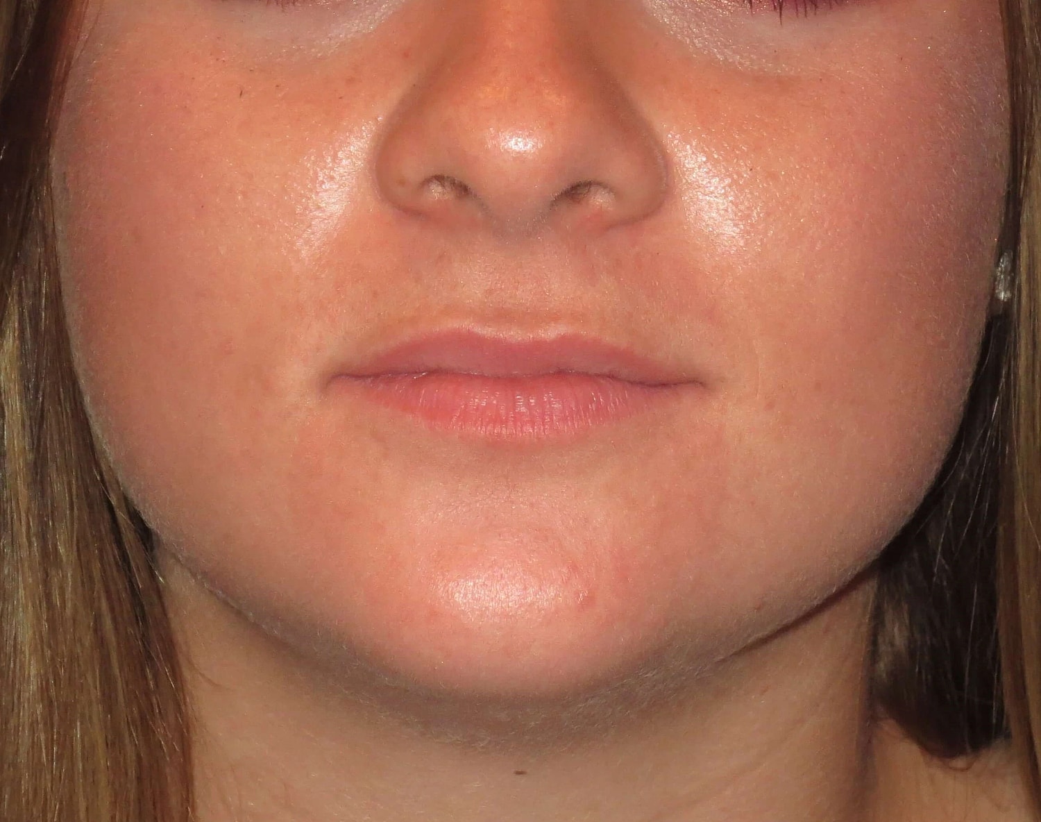 Lip Filler Before & After