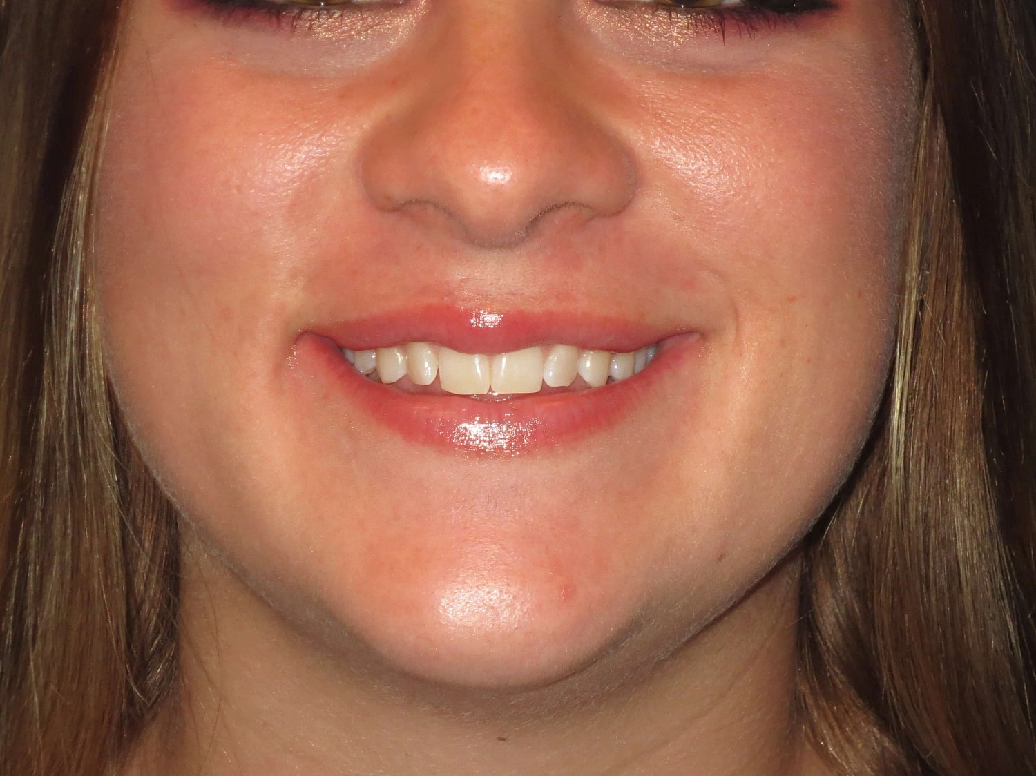 Lip Filler Before & After