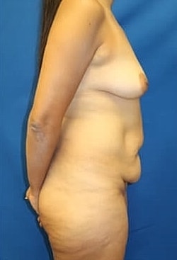 Mommy Makeover Before & After