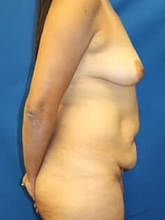 Mommy Makeover Before & After