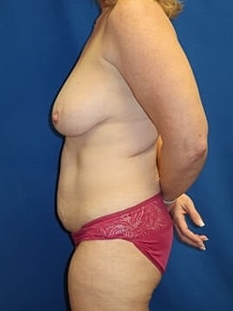 Mommy Makeover Before & After