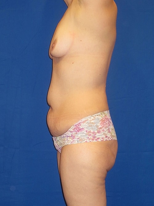 Mommy Makeover Before & After