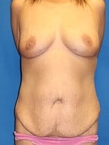 Mommy Makeover Before & After